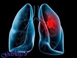 پیشبینی زیاد کردن مرگومیرِ زنان مبتلا به سرطان ریه